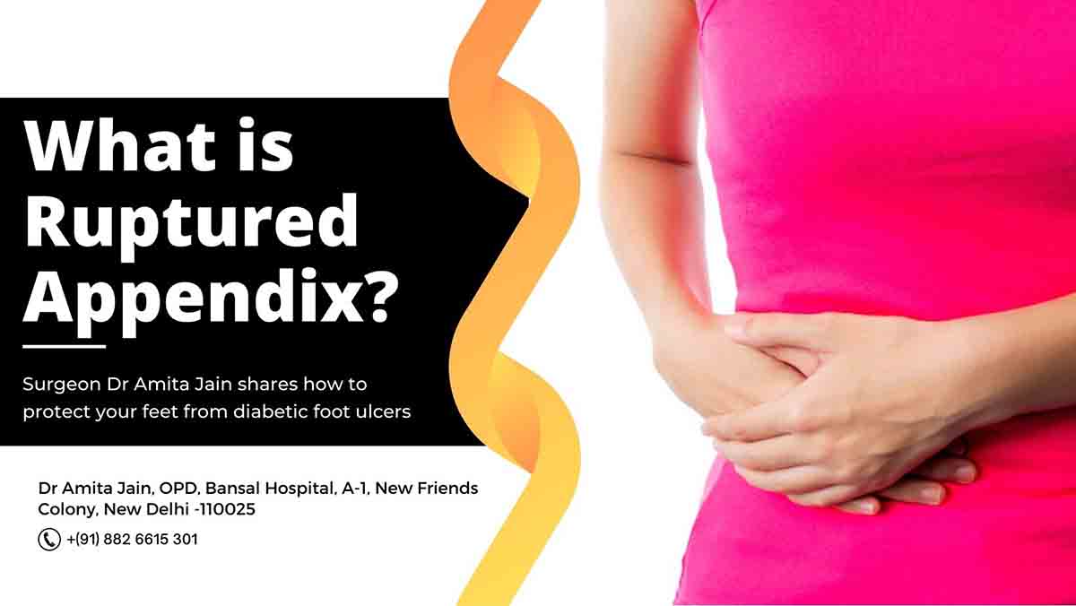 Ruptured Appendix by Dr Amita Jain