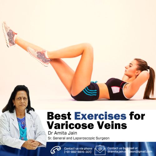 best vericose vein surgeon Dr Amit Jain