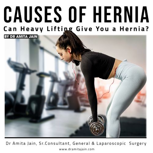 Can Heavy Lifting Give You a Hernia