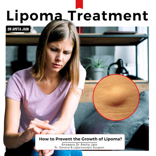 Dr Amita Jain best laparoscopic Surgeon for lipoma