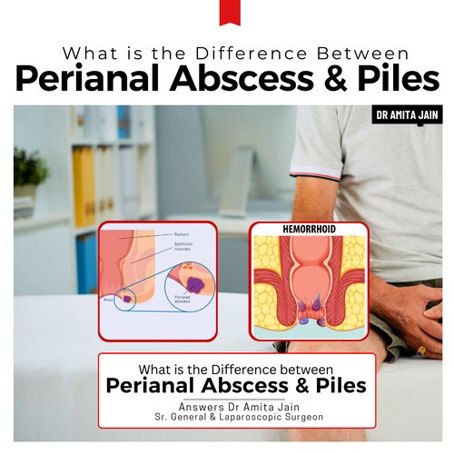 Dr Amita Jain best doctor and surgeon for Piles treatment