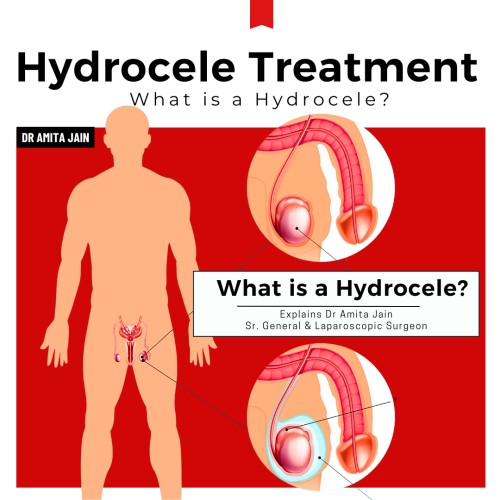 What is a Hydrocele? Explains Leading Surgeon Dr Amita Jain