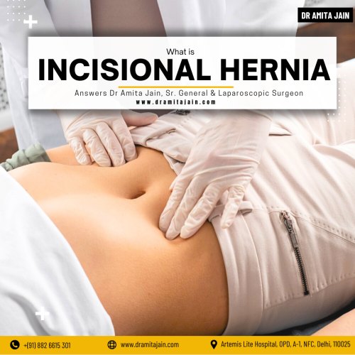 Best incisional hernia surgeon in Delhi Dr Amita Jain