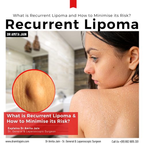 Dr Amita Jain Best Lipoma Surgeon in Delhi and India