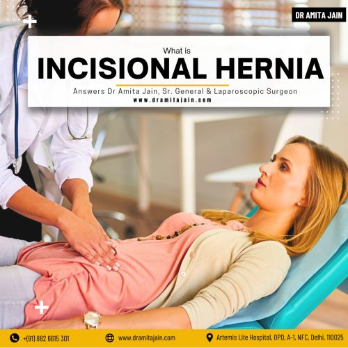 Dr Amita Jain best incisional hernia surgeon in Delhi