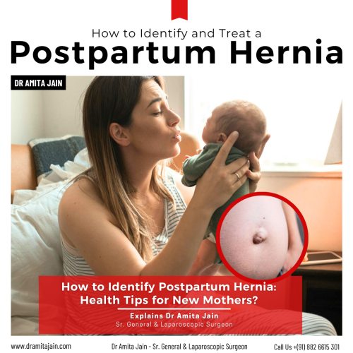 Dr Amita Jain best surgeon for hernia treatment in Delhi