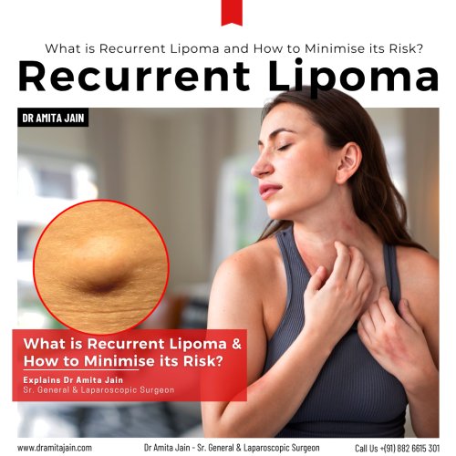 Dr Amita Jain best surgeon for Lipoma treatment in Delhi