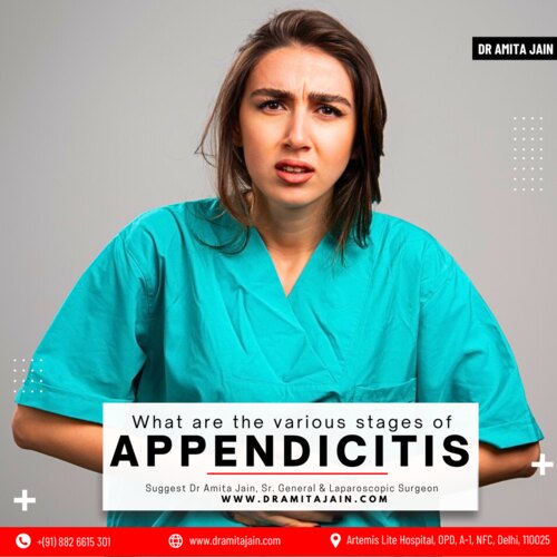 Appendicitis: Stages and Complications You Should Know