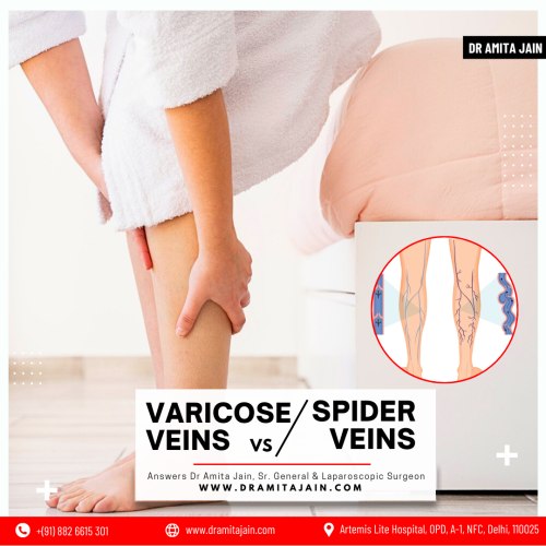 What are Varicose Veins and Spider Veins?