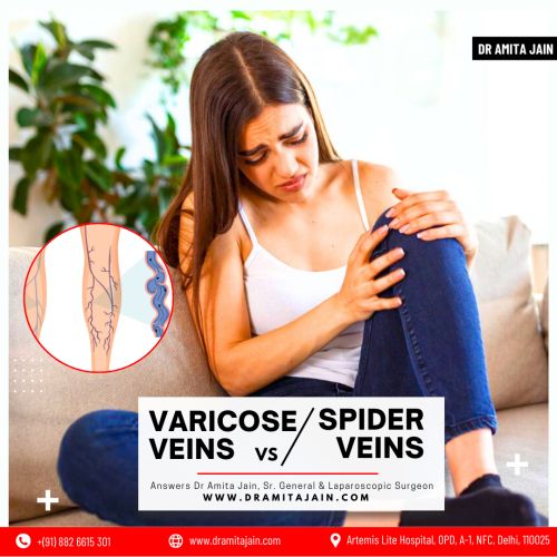 What are Varicose Veins and Spider Veins
