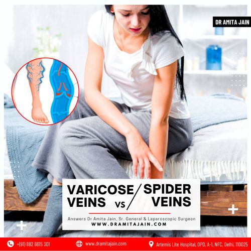 Varicose Veins Treatment in Delhi Dr Amita Jain