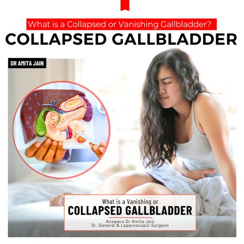 treatment for vanishing gallbladder by Dr Amita Jain