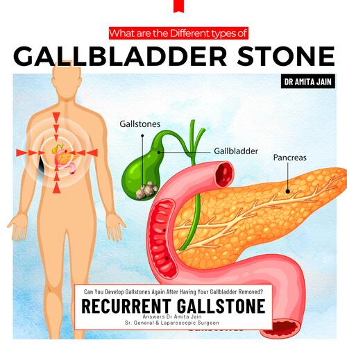 Dr Amita Jain Sr. General & Laparoscopic Surgeon for gallbladder in delhi