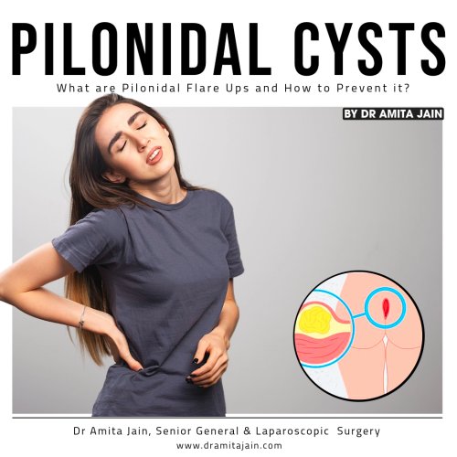 Pilonidal Flare-Ups and How to Prevent It