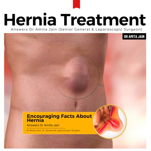 Dr Amita Jain best hernia repair surgeon in Delhi 