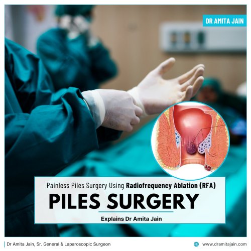 Dr Amita Jain Painless Piles Surgery Radiofrequency Ablation