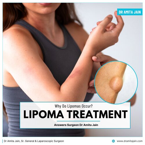 best lipoma speciaist in delhi_dr amita jain