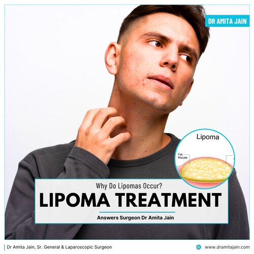 best lipoma surgeon in delhi Dr amita jain