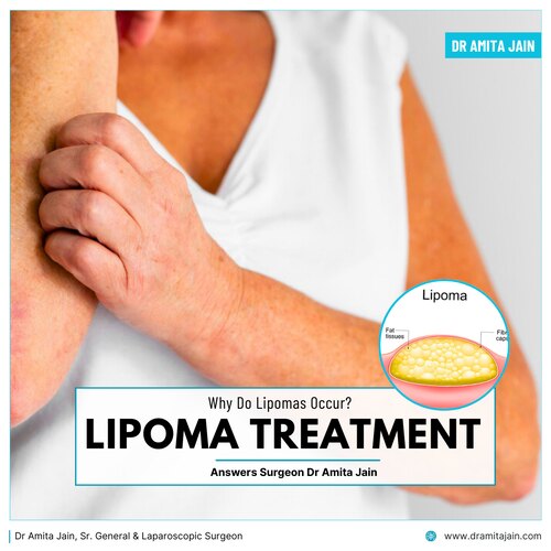 best surgeon specialist for lipoma in delhi_Dr amita jain