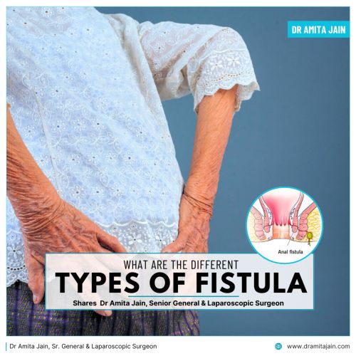 Intersphincteric Fistula treatment surgery in Delhi Dr Amita Jain Sr General Laparoscopic Surgeon