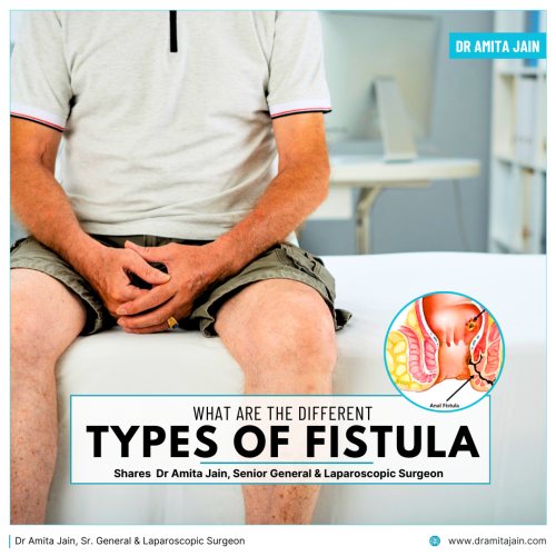 Best Fistula treatment surgery by Dr Amita Jain Sr General Laparoscopic Surgeon