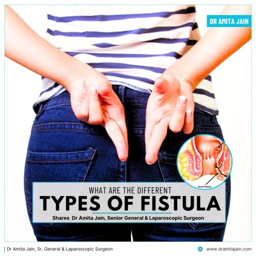 Fistula treatment surgery in Delhi Dr Amita Jain Sr General Laparoscopic Surgeon