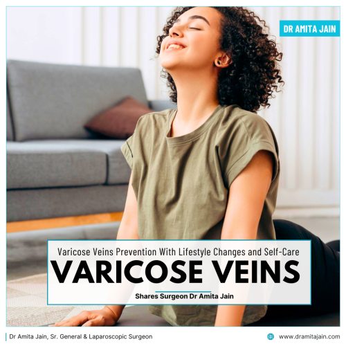 Varicose Veins Prevention by Dr Amita Jain Senior General Surgeon