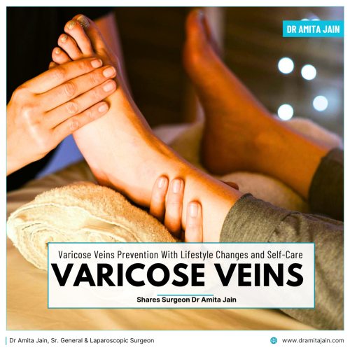 Varicose Veins Prevention by Dr Amita Jain Senior General Surgeon