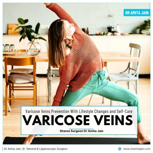 Varicose Veins Prevention by Dr Amita Jain Senior General Surgeon