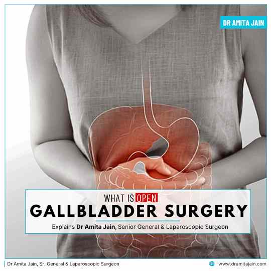 Open Gallbladder Surgery in Delhi by Dr Amita Jain Senior General Laparoscopic Surgeon