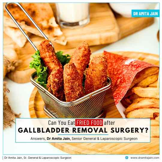 Can You Eat Fried Food After Gallbladder Removal Surgery