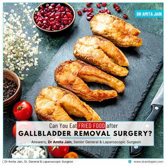 Can You Eat Fried Food After Gallbladder Removal Surgery