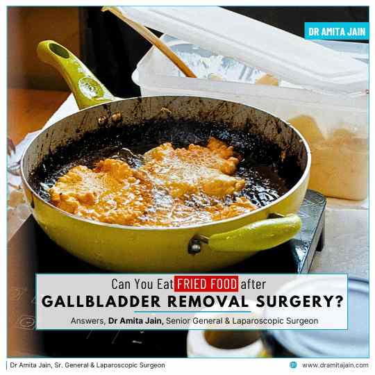 Can You Eat Fried Food After Gallbladder Removal Surgery