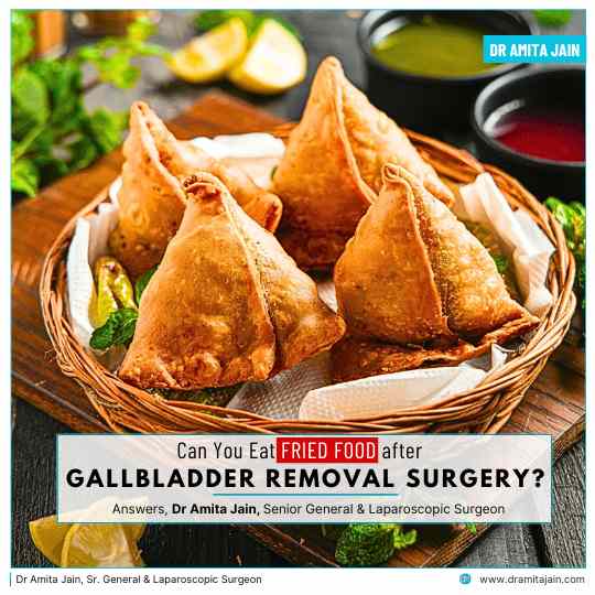 Can You Eat Fried Food After Gallbladder Removal Surgery