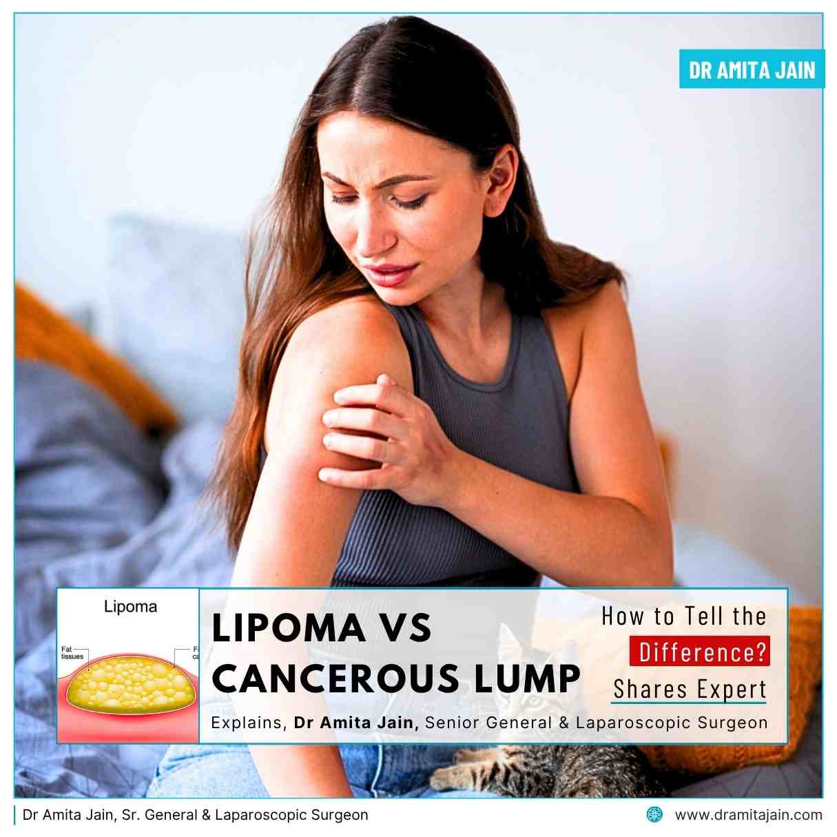 Dr Amita Jain Lipoma Surgeon_in Delhi