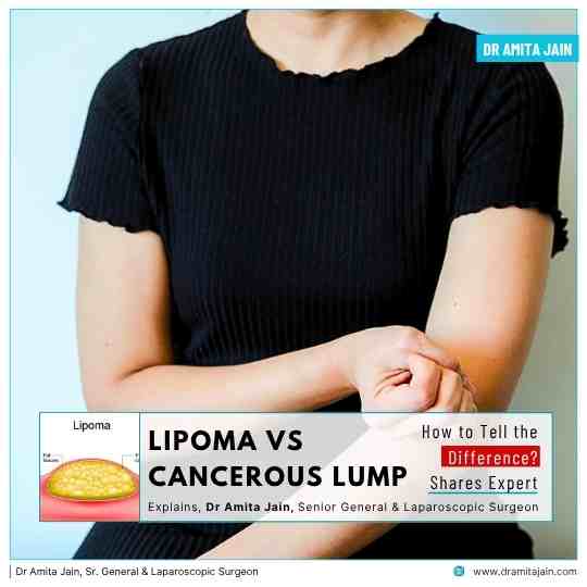 Dr Amita Jain best lipoma surgeon in Delhi NCR