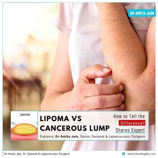 Dr Amita Jain_best lipoma specialist in delhi