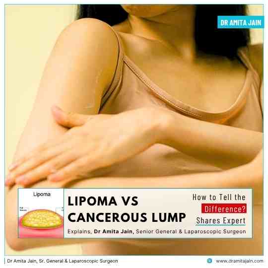 Dr Amita Jain_best lipoma surgeon in delhi