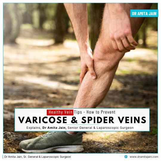 Spider and Varicose Vein Treatment by Dr Amita Jain