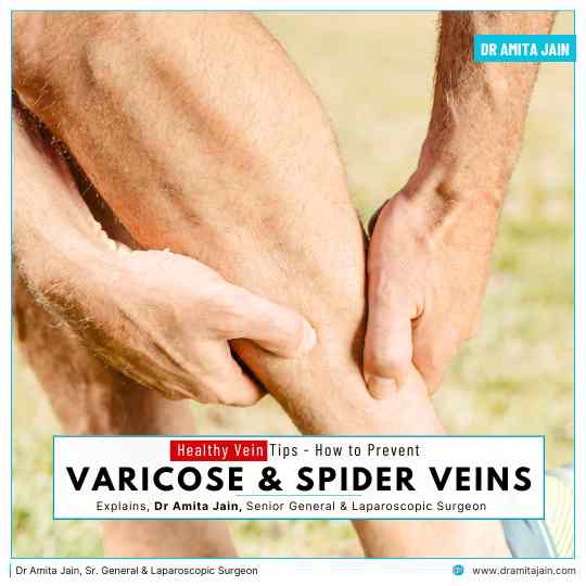  Does Exercise Help Prevent Varicose Veins