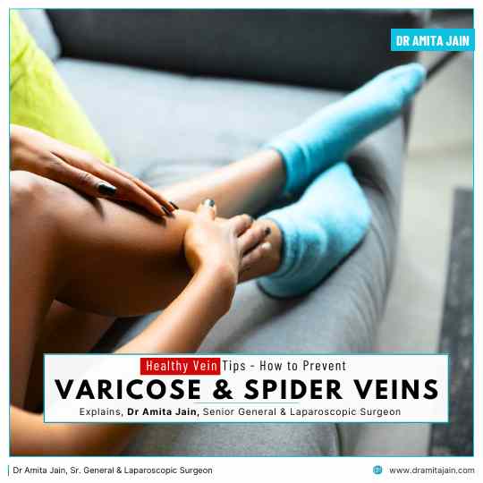 Spider and Varicose Vein Treatment by Dr Amita Jain