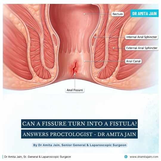 Can a Fissure Turn Into a Fistula Answers Proctologist Dr Amita Jain