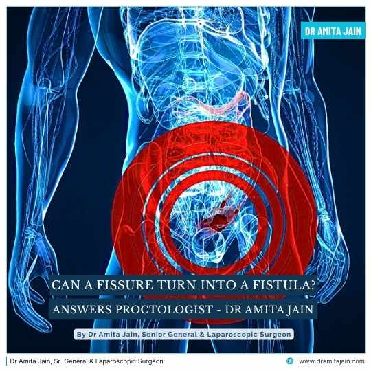 Can a Fissure Turn Into a Fistula Answers Proctologist Dr Amita Jain