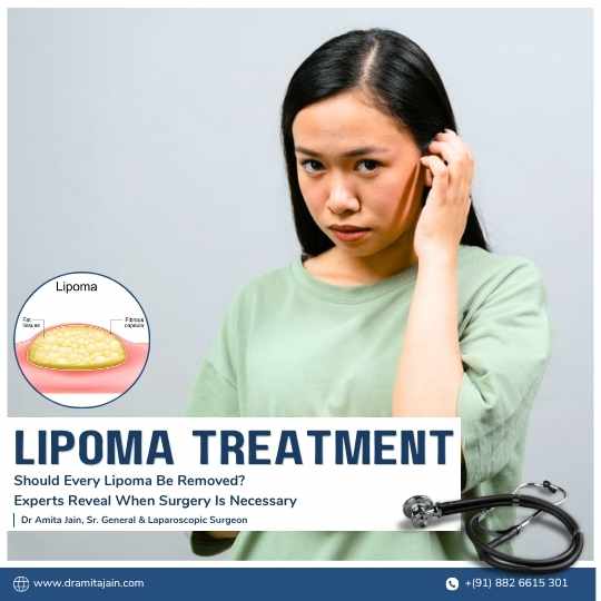 Lipoma treatment surgery in Delhi by Dr Amita Jain