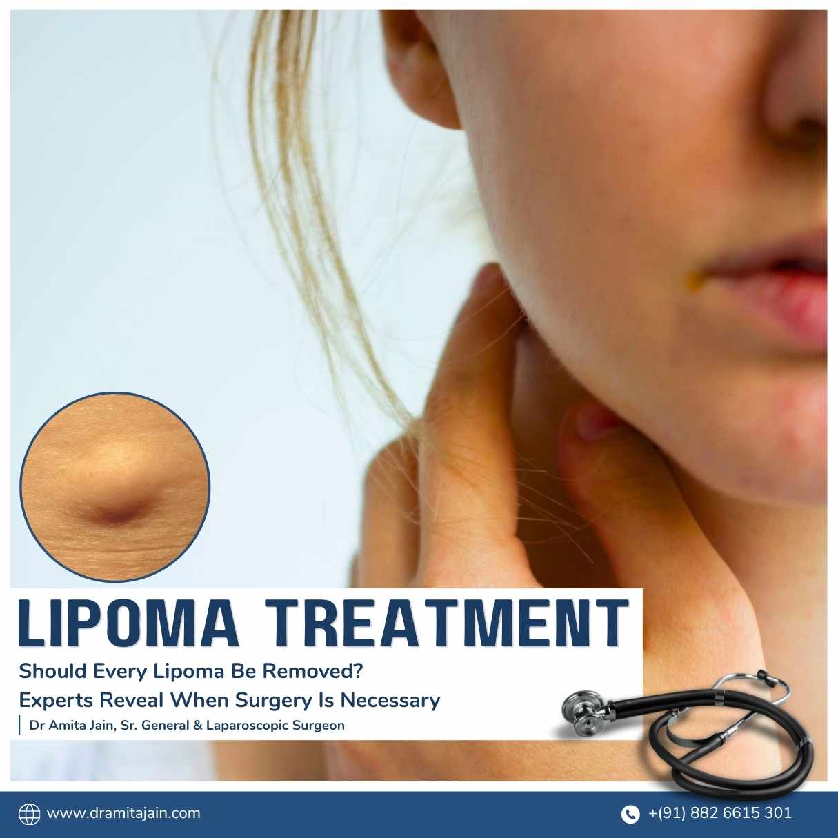 Lipoma treatment surgery in Delhi by Dr Amita Jain
