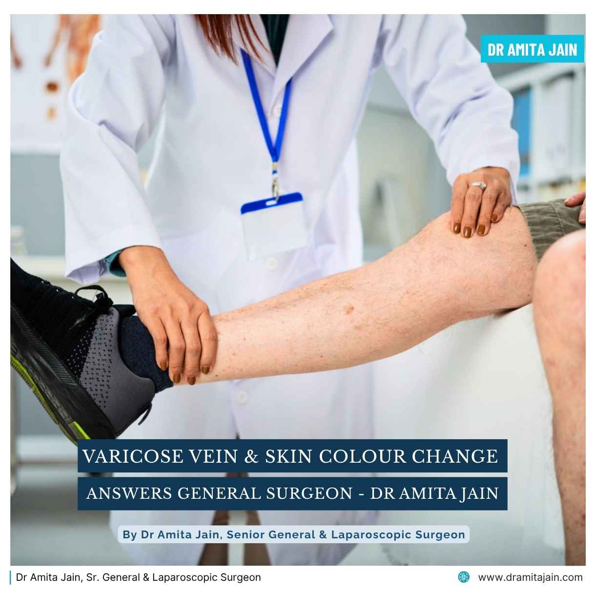 Varicose Veins and Skin Color Change treatment surgeon Dr Amita Jain