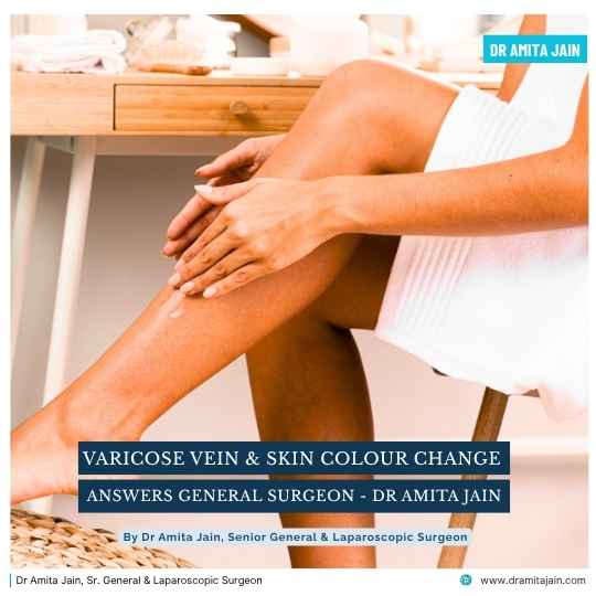Varicose Veins and Skin Colour Change treatment surgeon Dr Amita Jain