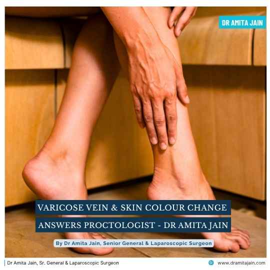 Varicose Veins and Skin Color Change treatment surgeon Dr Amita Jain