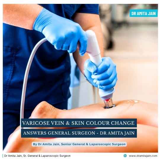Varicose Veins and Skin Colour Change treatment surgeon Dr Amita Jain