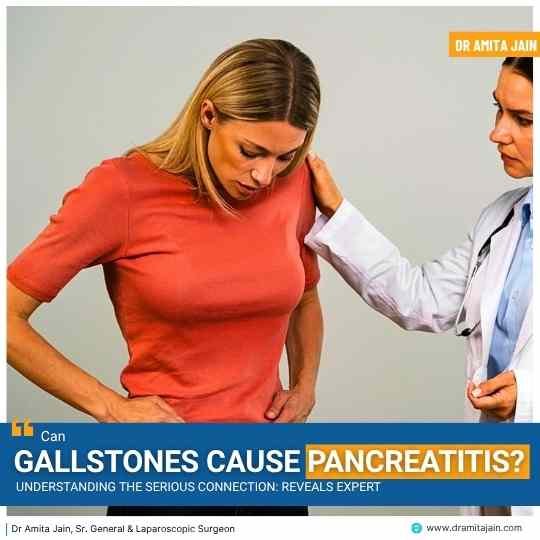 Can Gallstones Cause Pancreatitis? Understanding the Serious Connection: Reveals Expert